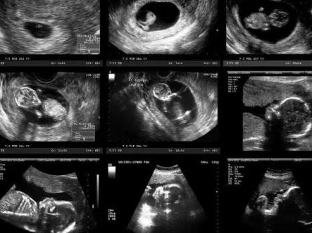 四川地区有哪些私立的机构可以做试管技术？卵巢早衰的8大征兆，骨折发病率大大增加？